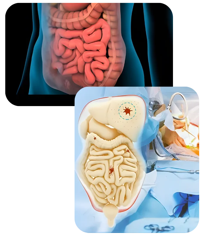 Cytoreductive Surgery