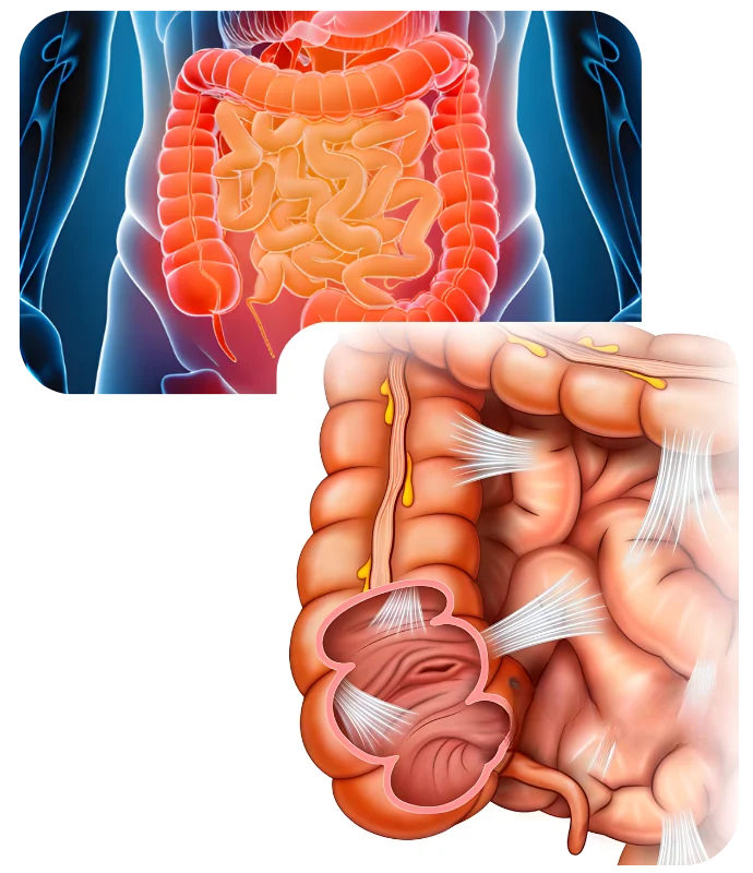 PERITONEAL SURFACE MALIGNANCIES